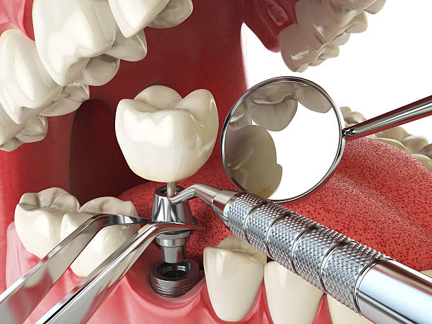 Best Emergency Wisdom Teeth Removal in St George, KS
